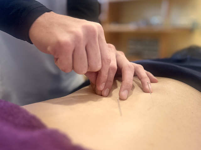 局所鍼治療・局所鍼